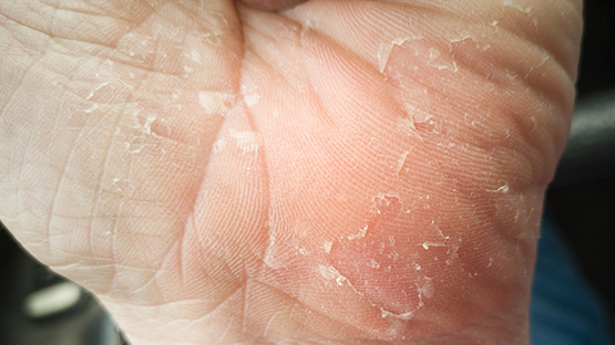 image of a patient's hand with a common skin condition